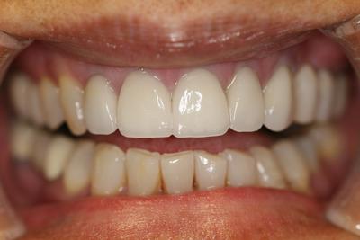 Restored with Veneers