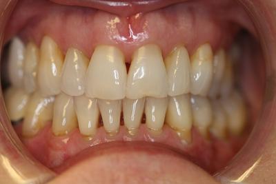 Gaps, Chips and Discoloration