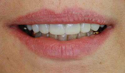 Veneers Restored Natural Appearance